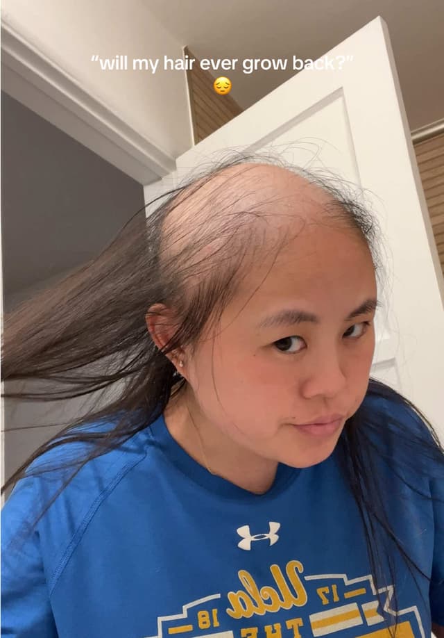 🥲❤️‍🩹 #alopecia #hairgrowth #hair #hairjourney #hairregrowth #hairloss #alopeciaareata #alopeciaawareness #telogeneffluvium 